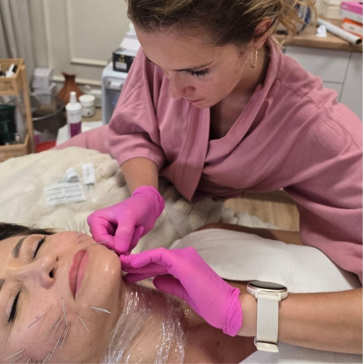 Akupunktura kosmetyczna twarzy – delikatna stymulacja skóry w Rzeszowie